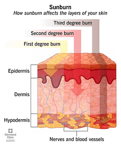 Image showing effects of sunburn on skin