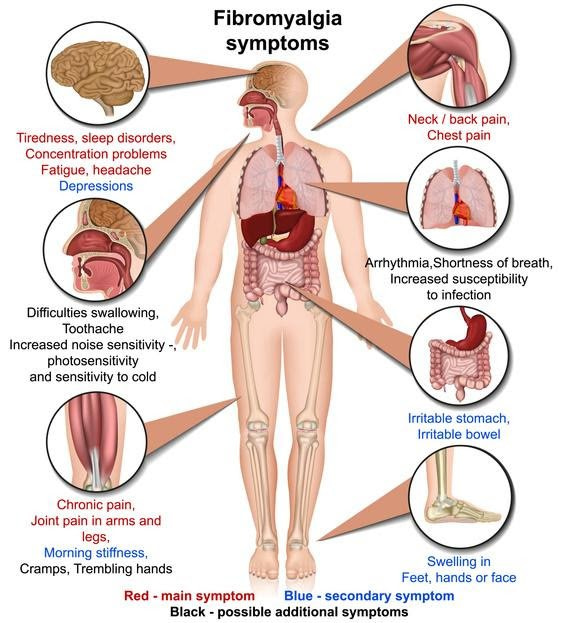 Map of fibromyalgia symptoms