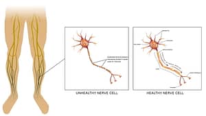 picture of health and unhealthy nerves
